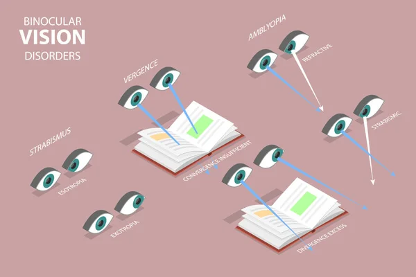 Isometric Flat Vector Conceptual Illustration Binocular Vision Disorders Medical Sight — Stock Vector