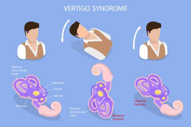 3D Isometric Flat Vector Conceptual Illustration of Vertigo Syndrome , BPPV clipart