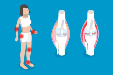 3D Isometric Flat Vector Conceptual Illustration of Rheumatism, Osteoarthritis and Rheumatoid Arthritis