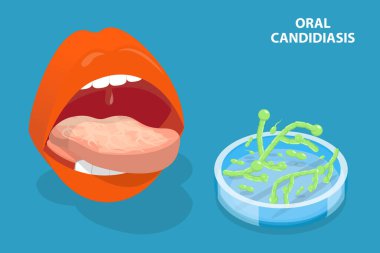 3D Isometric Flat Vector Conceptual Illustration of Oral Candidiasis, Yeast Infection clipart