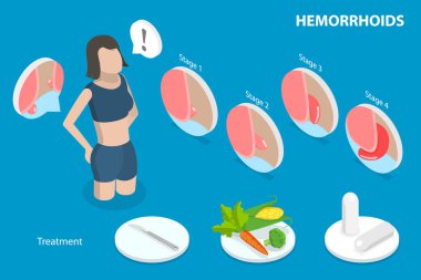 3D Isometric Düz Vektör Hemoroidlerin Kavramsal İllüstrasyonu, Alt Rektumda Şişmiş Damarlar