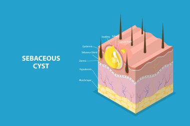 3D Isometric Düz Vektör Sebasyalı Kistin Kavramsal İllüstrasyonu, Tıbbi Diyagram