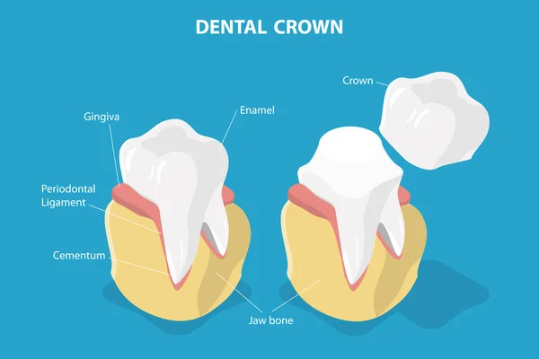 Isometric Flat Vector Conceptual Illustration Dental Crown Restoration Tooth Prosthesis — Stockový vektor