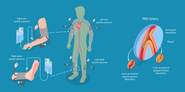 ABI Testinin 3B Isometric Düz Vektör İllüstrasyonu, Limb İsschemia Diagnosis