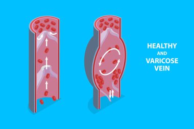 3 Boyutlu Isometric Düz Vektör Sağlıklı ve Varisli Damar, Eğitim Tıbbi Diyagramı