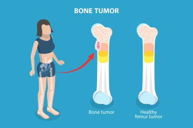 3B Isometric Düz Vektör Kemik Tümörü İllüstrasyonu, Ortopedik Sorunu