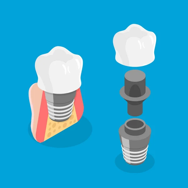 Boyutlu Isometric Düz Vektör Diş Mplantı Diş Protezi — Stok Vektör