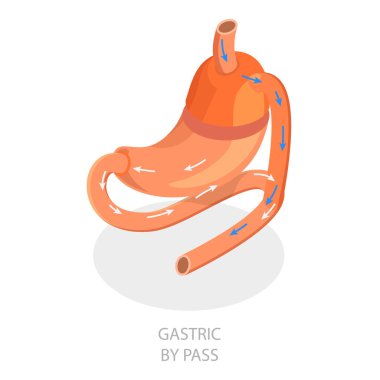 3 boyutlu Isometric Düz Vektör İllüstrasyon Bariatrik Cerrahi Türleri, Kolsuz Gastrectomi. Madde 2