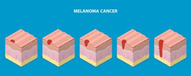 3D Isometric Flat Vector Illustration of Melanoma Cancer, Dermatology and Skin Health clipart