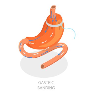 3 boyutlu Isometric Düz Vektör İllüstrasyon Bariatrik Cerrahi Türleri, Kolsuz Gastrectomi. Madde 3