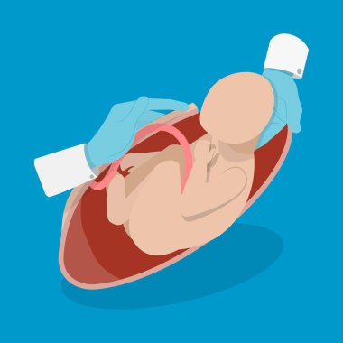 3D Isometric Flat Vector Illustration of Cesarean Section, Medical Surgery and Abdominal Incision clipart
