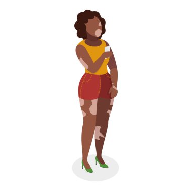 Vitiligo 'lu 3D Isometric Düz Vlat Vector Seti, Teninde Işık Lekeleri. Madde 1