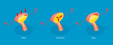 3D Isometric Flat Vector Illustration of Urinary Incontinence, Diagram Outlining Different Types of Incontinence Problems. Stress, Overflow, and Urge clipart