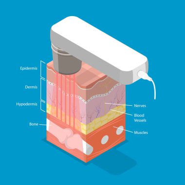 3 Boyutlu Isometric Laser Terapisinin Düz Vektör İlülasyonu, Hasta Ağrısını Verme ve İyileştirme Uyarlaması