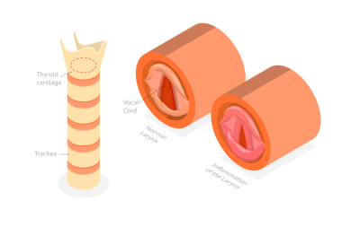 Larenjitin 3B Isometric Düz Kavramsal İllüstrasyonu