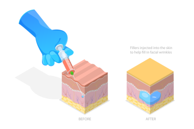 Enjekte Edilebilir Kozmetik Doldurucu, Kırışıklık Önleyici Enjeksiyonunun 3B Isometric Düz Kavramsal İllüstrasyonu