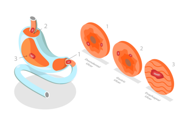 Peptik Ülser Mide Hastalığı, Gastrit ve İltihaplanmanın 3 boyutlu Isometric Düz Kavramsal İllüstrasyonu