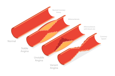 3D Isometric Flat Angina Tipleri, Tıbbi Eğitim Diyagramı