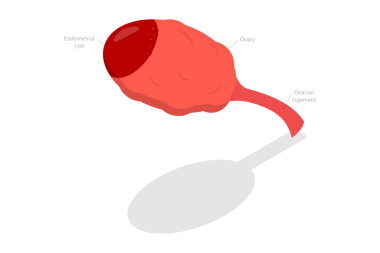 3D Isometric Düz Endometriyomun Kavramsal İllüstrasyonu, Yumurtalık Kisti