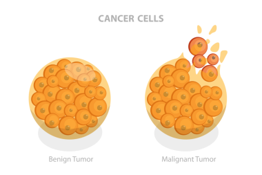 Kanser hücrelerinin 3 boyutlu Isometric Düz Çizimi, Tümör Gelişimi