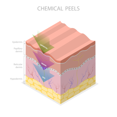 Cilt Kimyasal Kabuğu, Güzellik Estetik Tedavisinin 3 Boyutlu Düz Çizimi