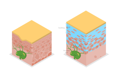 3D Isometric Düz Lenf İllüstrasyonu, Lenfatik Sistem Bozukluğu