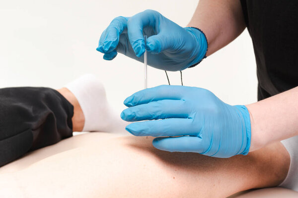 Детальный крупный план нескольких игл иглы иглы, вставленных в ногу человека, подчеркивая альтернативные методы медицины