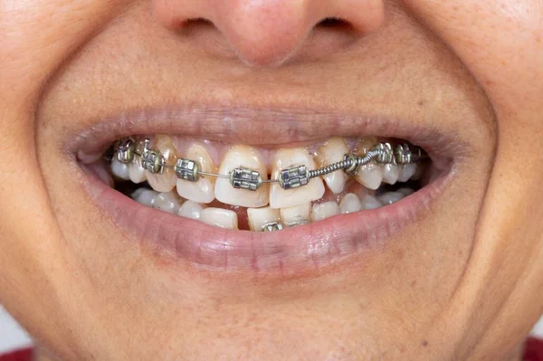 Metallspangen Zähnen Einer Indischen Britisch Asiatischen Frau Mittleren Alters Mündlich lizenzfreie Stockbilder