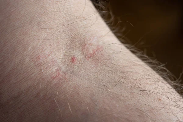 Small mark left by the needle on the elbow pit of a Caucasian male arm. Close up shot, unrecognizable person..