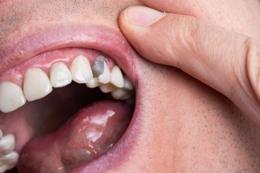 Beyaz erkek. Ağzı açık ve dişleri kırık. Diş tedavisi sonrası azı dişi kırılmış. Kalıcı yeni taçtan önce koyu gri diş çimentosu. Makro görüntüyü kapat.