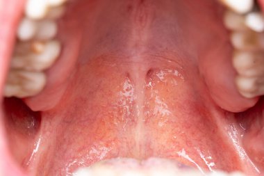 Kafkas erkek ağız boşluğu, ağız çatısı ve fovea palatin kanalları. Yaklaş makro çekim..