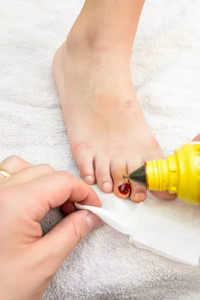 First aid close-up of a child\'s toenail injury. In summer, small accidents in the home and injuries to bare feet are common