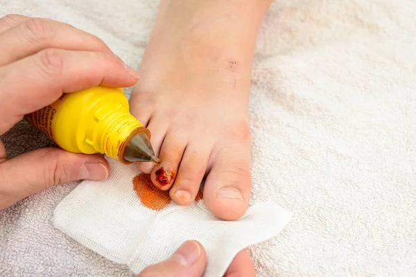 First aid close-up of a child\'s toenail injury. In summer, small accidents in the home and injuries to bare feet are common
