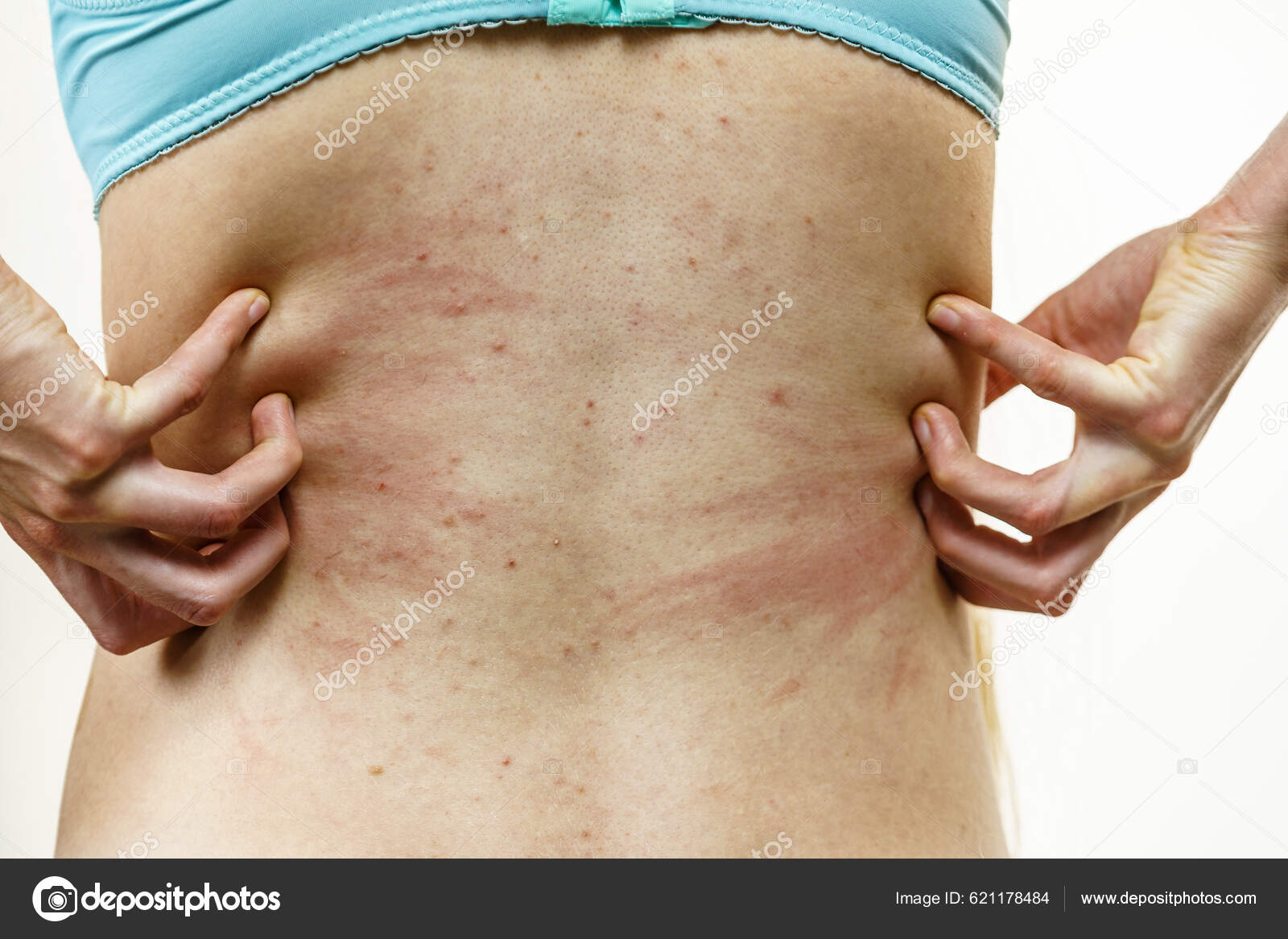 Itchy Skin Dermatitis Food Allergies Woman Showing Her Back Acne Stock  Photo by ©Voyagerix 621178484