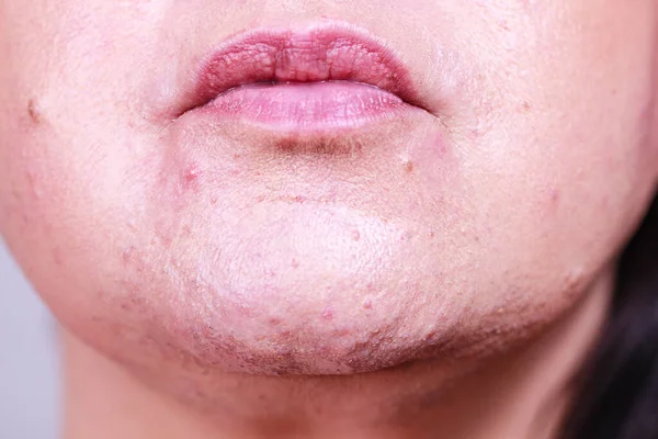 成熟的女人脸上露出粉刺和痣 成年女性的下巴上没有红斑 健康问题 皮肤病 — 图库照片