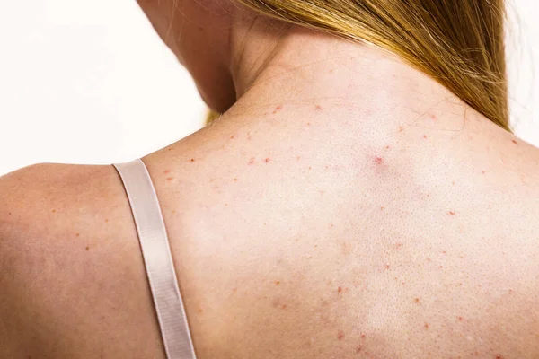 健康上の問題皮膚病 若い女性がにきび 赤い斑点で彼女の背中を示しています ティーン女の子とともに多くのにきび — ストック写真