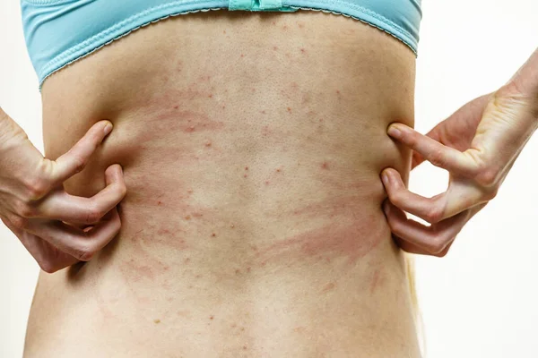 かゆみ肌 皮膚炎 食物アレルギー 女性はにきび 赤い斑点で彼女の背中を示す かゆみを持つ女性 アレルギー性発疹で彼女の体を引っかきます — ストック写真