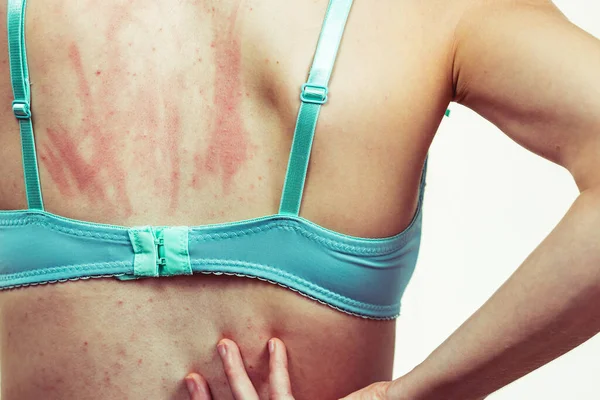 Woman Allergy Rash Scratching Her Itchy Back Young Female Acne — 图库照片