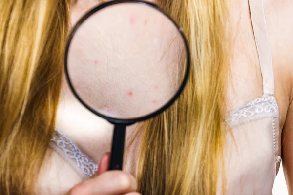 Zdravotní Problém Kožní Onemocnění Mladá Žena Ukazuje Svůj Výstřih Akné — Stock fotografie