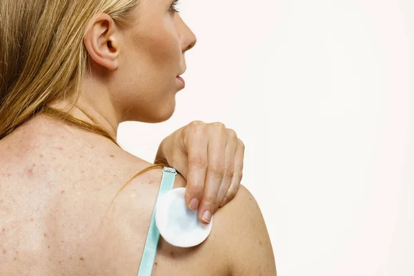 Behandlung Für Erwachsene Akne Problem Frau Mit Roten Flecken Auf — Stockfoto