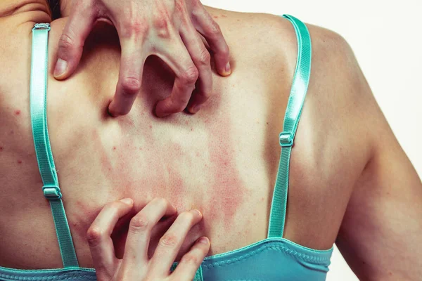 Woman Allergy Rash Scratching Her Itchy Back Young Female Acne — Stok Foto