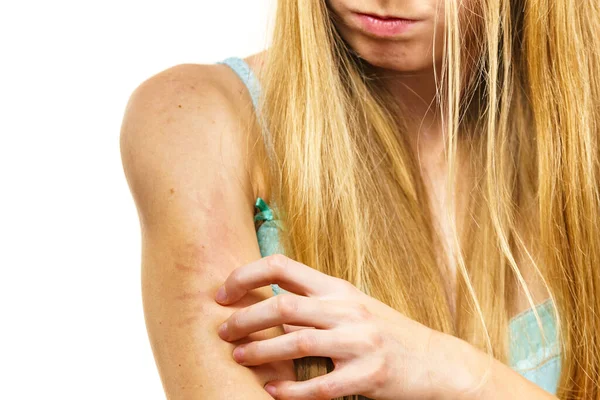 かゆみ肌 皮膚炎 食物アレルギー かゆみを持つ女性アレルギー性発疹で彼女の腕を引っ掻いて — ストック写真