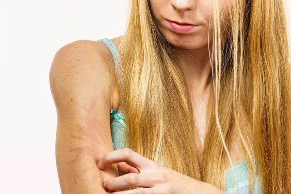 Kulit Gatal Dermatitis Alergi Makanan Wanita Yang Gatal Menggaruk Lengannya — Stok Foto
