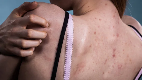 Zdravotní Problém Kožní Onemocnění Mladá Žena Ukazuje Záda Akné Červené — Stock fotografie