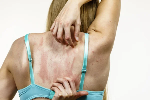 Молода Жінка Страждає Сверблячкою Шкірі Подряпає Свербіж Назад Алергічна Реакція — стокове фото