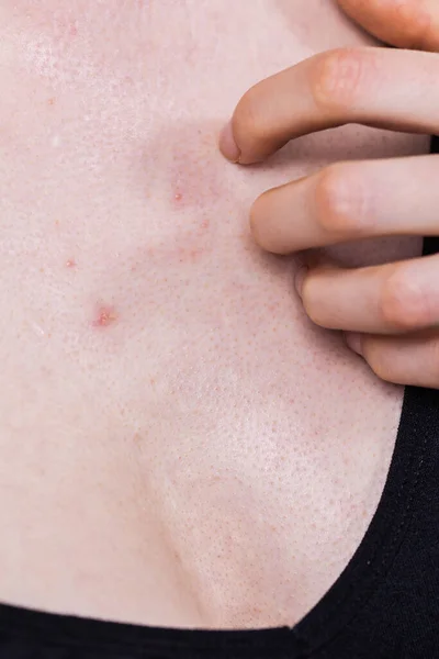 Kvinna Med Finnar Röda Prickar Bröstet Dermatoser Hudproblem Dermatologiska Problem — Stockfoto