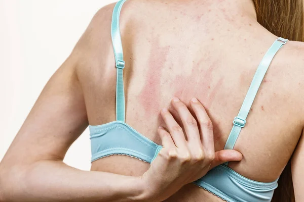 健康上の問題皮膚病 若い女性がにきび 赤い斑点で彼女の背中を示しています 女性傷彼女のかゆく体とともにアレルギー発疹 — ストック写真