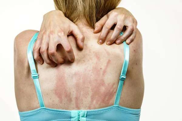 Jovem Mulher Sofrendo Coceira Pele Coceira Nas Costas Reação Alérgica — Fotografia de Stock