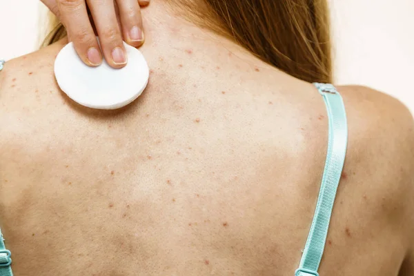 Health Problem Skin Diseases Young Woman Acne Red Spots Back — Stock Photo, Image
