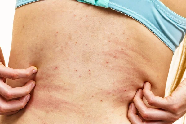 Itchy skin, dermatitis, food allergies. Woman showing her back with acne, red spots. Female having itching, scratching her body with allergy rash.